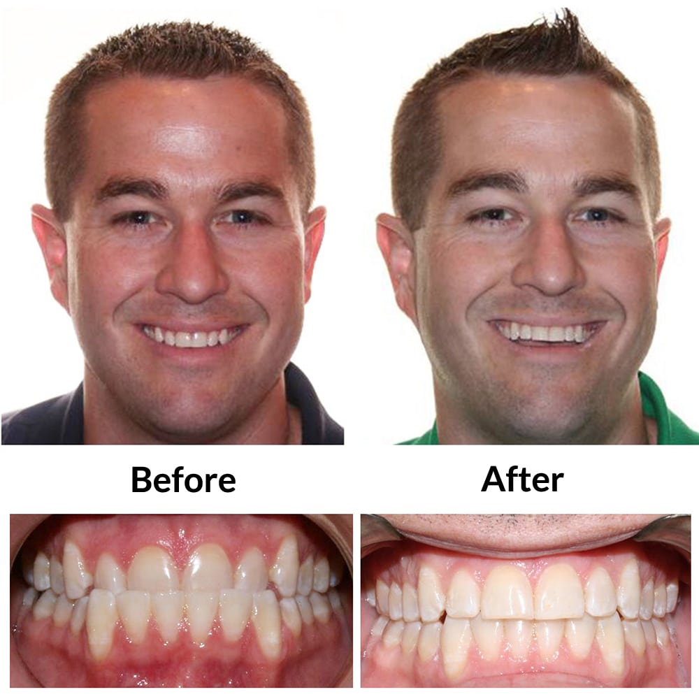 Invisalign Before and After Photo 1