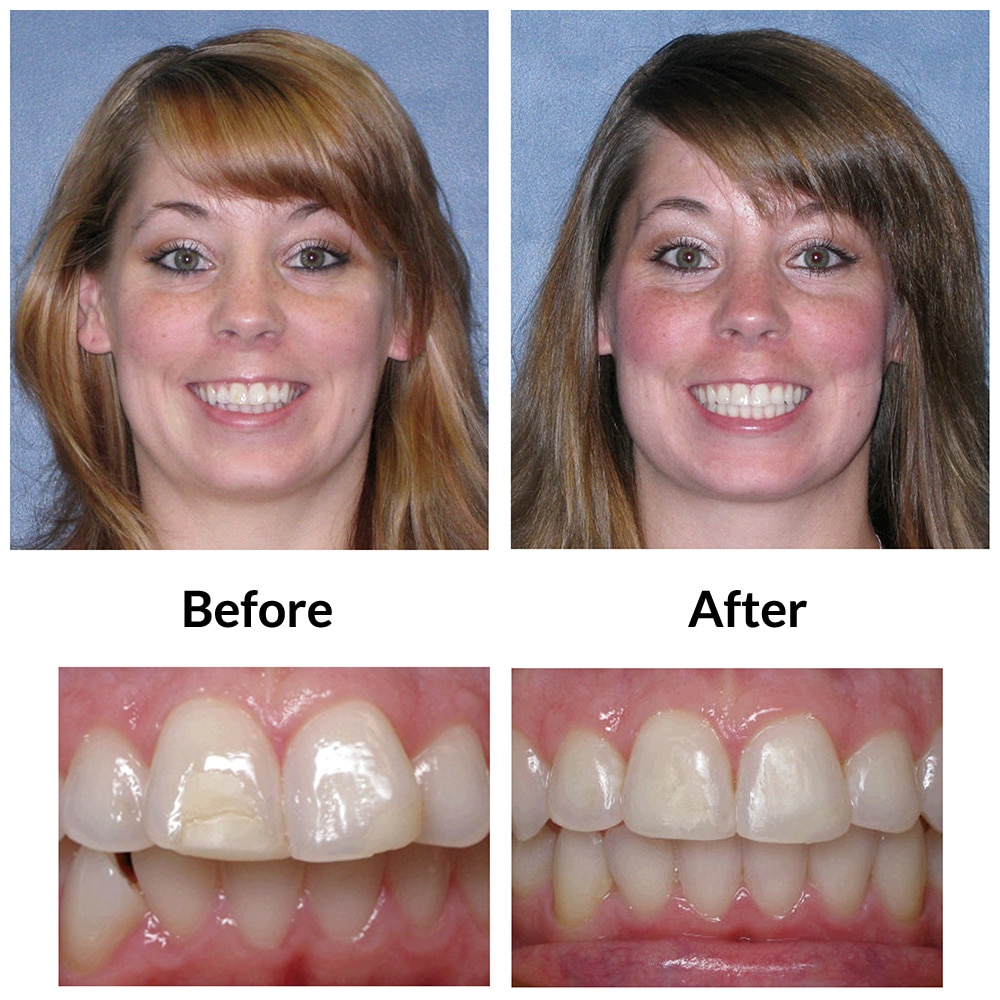 Invisalign Before and After Photo 2