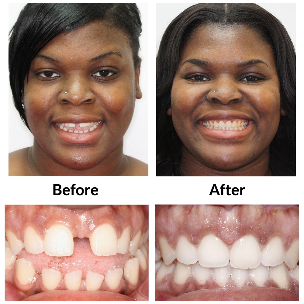 Invisalign Before and After Photo 3
