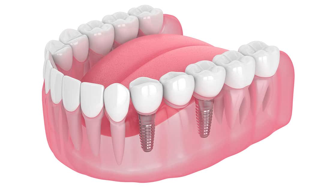 Implant Supported Bridge