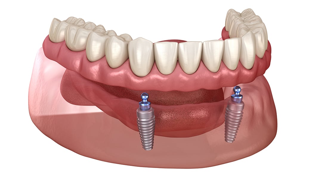 Implant Retained Denture