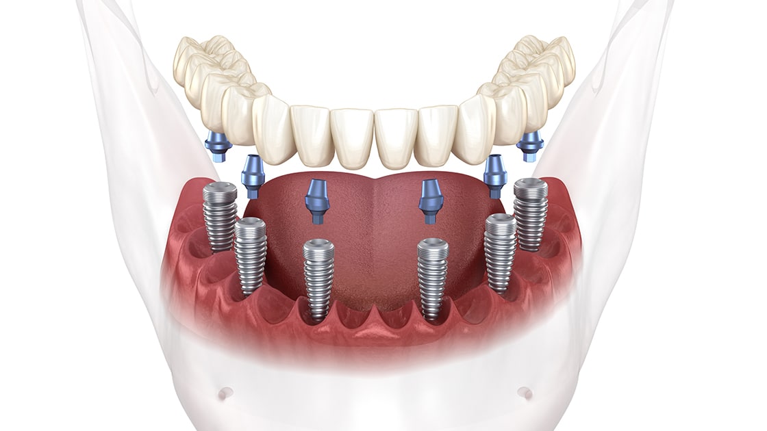 Implant Supported Denture Photo